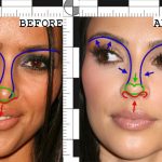 kim-kardashian-nose-job