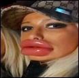botox
