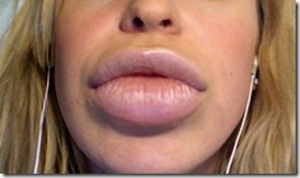 relleno labios