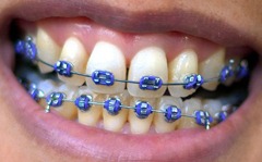 Deadly Fashion Braces)-
